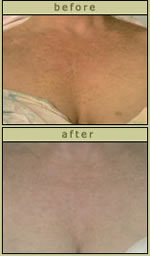 Skin Discoloration Before After